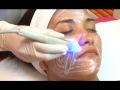 Radiofrecuencia Facial o Lifting sin cirugía