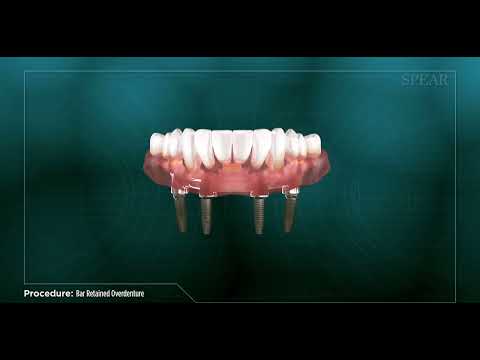 Bar Retained Overdenture