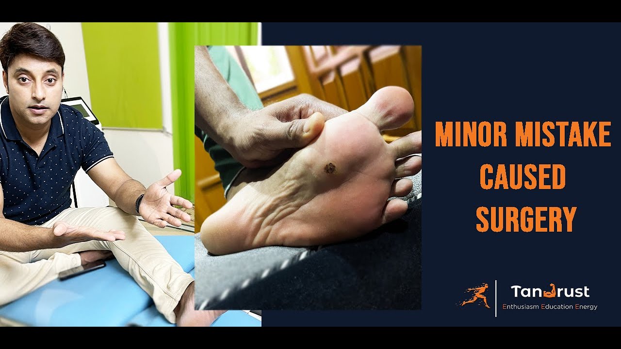 My Corn / Callus Foot Surgery Experience Zohaib Hasan YouTube