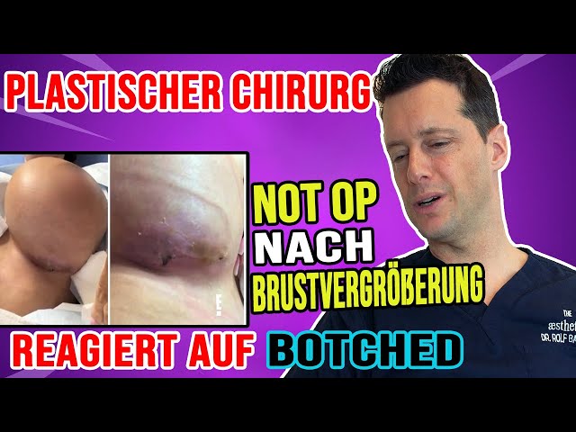 BRUSTVERGRÖSSERUNG mit 1200ML BRUSTIMPLANTATEN?! Plastischer Chirurg reagiert