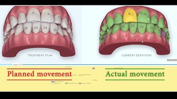 ✨️ HOW #INVISALIGN WORKS? Progress Assessment Tool in Orthodontics. iTero Element® scanner
