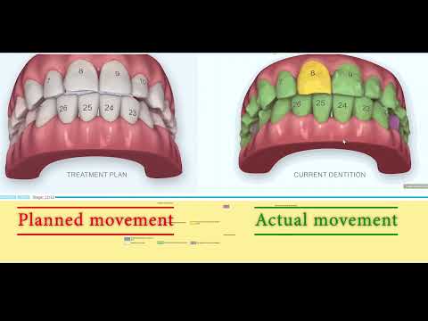 ✨️ HOW #INVISALIGN WORKS? Progress Assessment Tool in Orthodontics. iTero Element® scanner