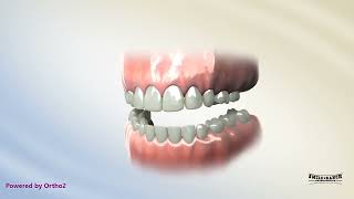 Ectopic Maxillary First Molar Eruption