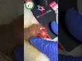 Genital warts  Cryopen #dermatologist  #cryosurgery #wartstreatment #genitalwarts #advancetreatment