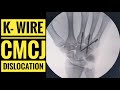 Kwire fixation of cmc carpometacarpal joint  dislocation