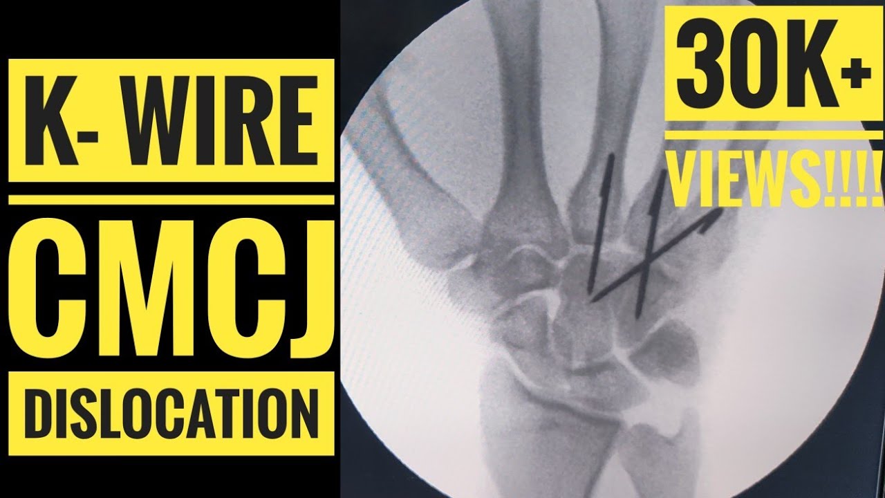 K wire Fixation Of CMC Carpometacarpal Joint Dislocation YouTube k-wire-fixation-of-cmc-carpometacarpal-joint-dislocation-youtube
