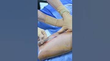 Discover VenaSeal: The Future of Vein Care