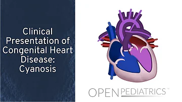 What percentage of Down syndrome babies have heart defects?
