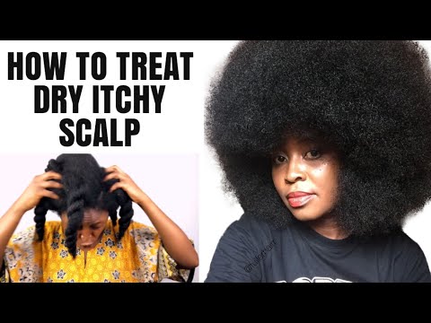 😳 ONLY 4 INGREDIENTS AND SCALP ITCHINESS WILL BE GONE FOREVER!
