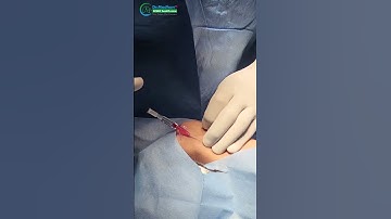 3 Easy Steps Radial arterial cannulation For beginners | Dr. Madhan