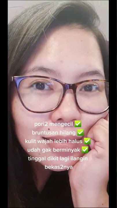Muka Jerawatan Parah Sampai Menjadi Glowing Dengan EREMES Skincare