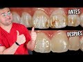 FLUOROSIS DENTAL ¿Como QUITAR estas MANCHAS de los DIENTES? ¡SI SE PUEDE! 🙌