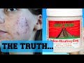 GETTING RID OF ACNE IN ONE WEEK EXPERIMENT|| Using Indian Healing Clay Mask Bentonite Clay