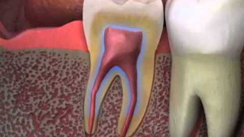Diagnosing Root Canal Therapy - Sample CAESY video
