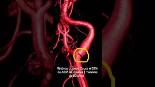 Web carotídeo : causa  hasta el 21% de ACV criptogenico en Jóvenes ! #acv  #stroke #neurologia