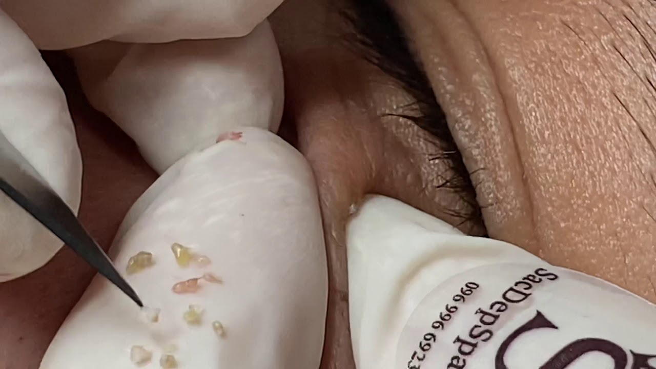 Rice acne for boyfriend, lấy nhân mụn gạo cho bạn trai ThuyTruong#25