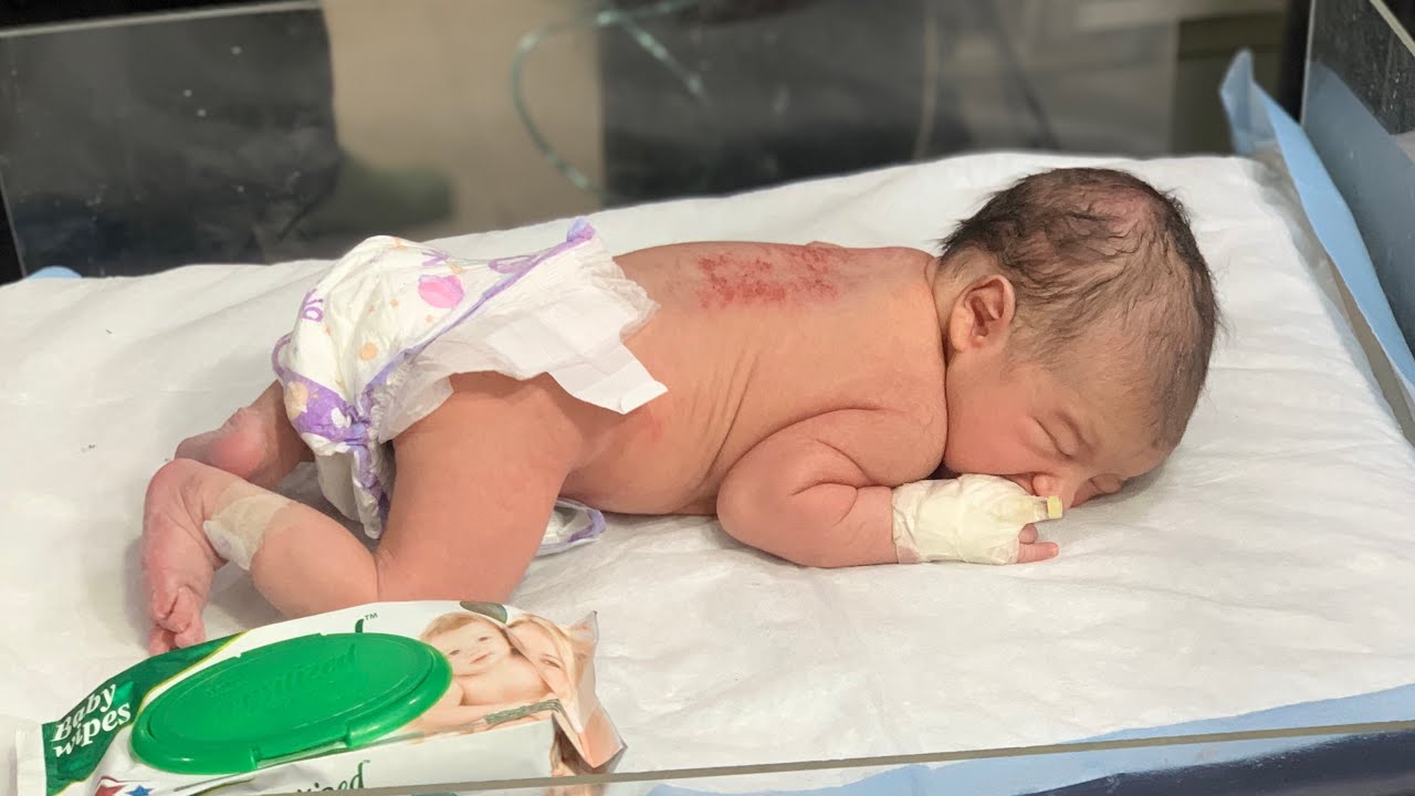 Affected Newborn Baby Care, Feeding & Bed Sore Assessment – Is the Baby Normal Now?