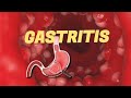 Chapter 5 Gastritis Medical Surgical Nursing الباب الخامس تمريض باطنة و جراحة 