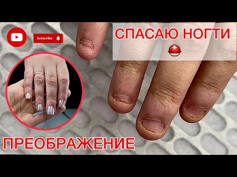 СГРЫЗЛА НОГТИ 😩 | КАК ВОССТАНОВИТЬ ТАКИЕ НОГТИ? #алена_лаврентьева #nails #ногти #подолог