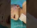 not cry afterbirth #seizer#new born baby#shick baby