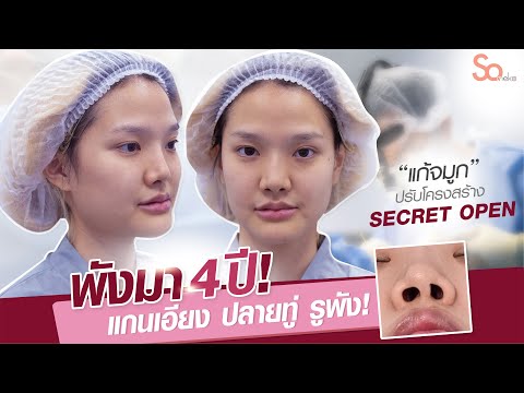 รีวิวจมูกopen พังมา4ปีฐานจมูกเอียงแก้ยังไงก็ไม่ตรง แก้ครั้งสุดท้ายที่someko