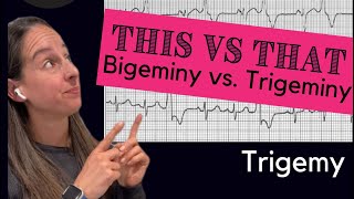 Bigeminy vs Trigeminy 🫀