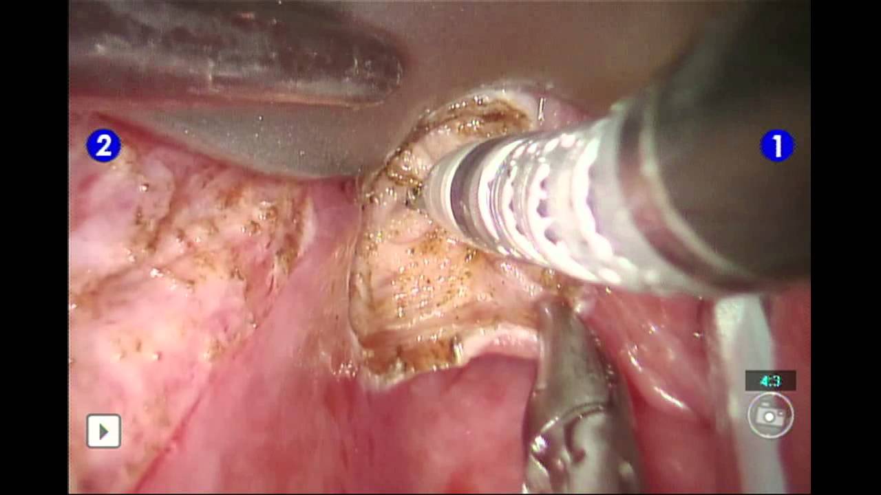 Left Pyriform Sinus SCC - YouTube