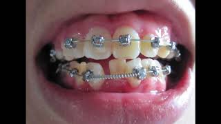 Braces - Before And After Time Lapse
