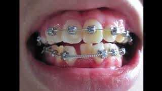 Braces - Before and After (Time Lapse)