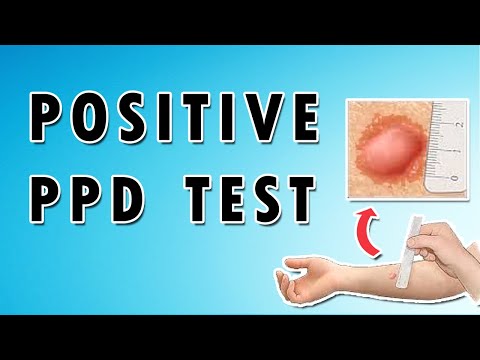 Positive PPD Test (Tuberculin Skin Test) - Interpretation, Diagnosis, and Tuberculosis