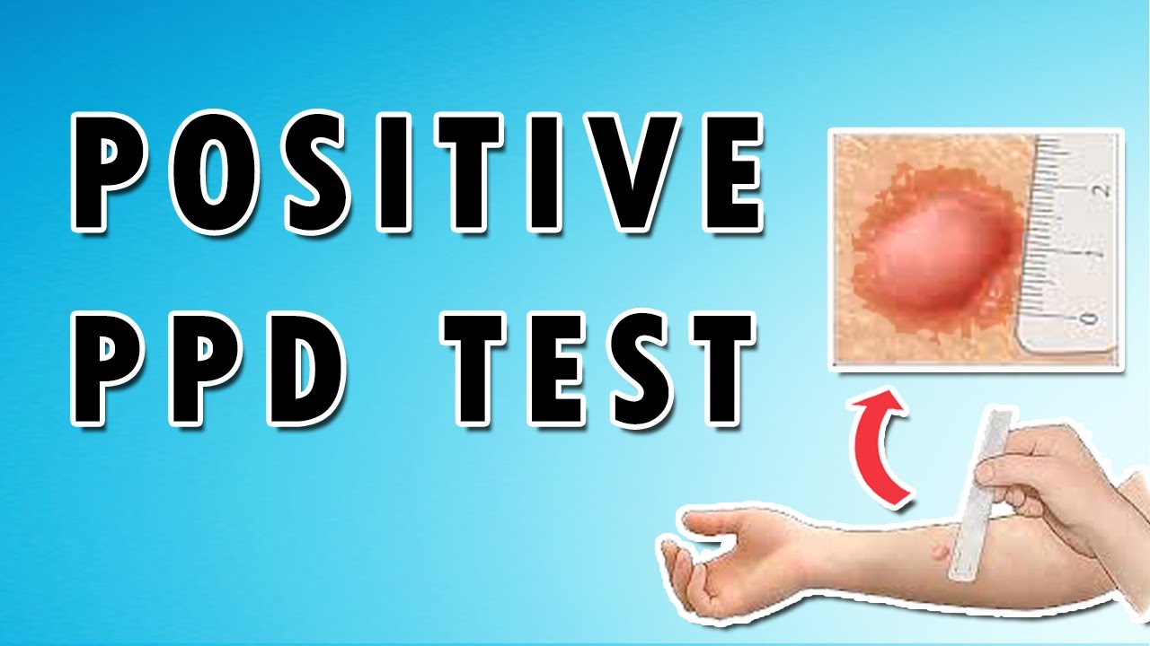 skrue maling Egen Positive PPD Test (Tuberculin Skin Test) - Interpretation, Diagnosis, and  Tuberculosis - YouTube
