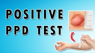 Positive PPD Test