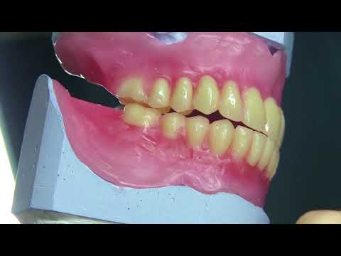 Video: Vaikein osa hammasproteeseissa on riippuvuus