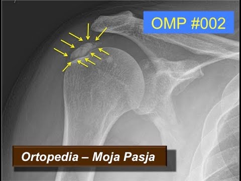 Zwapnienie w barku / stożku rotatorów | OMP #002