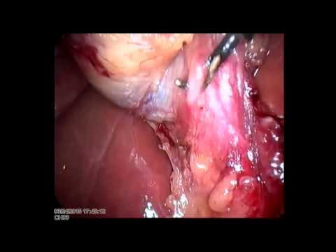 Lap Cholecystectomy 20150324 Unedited With Moderate Adhesions