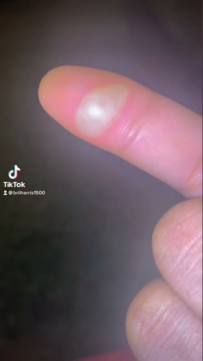 I burned myself 😵‍💫🥹