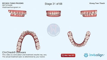 VIDEO CLINCHECK PHÂN TÍCH PHÁC ĐỒ ĐIỀU TRỊ NIỀNG RĂNG INVISALIGN