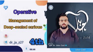 Operative_ ( Management of deep -seated carious lesion )
