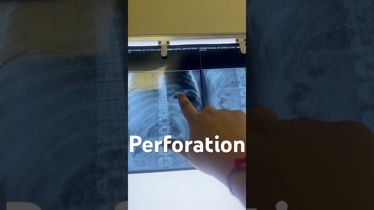 CXR - Perforation 