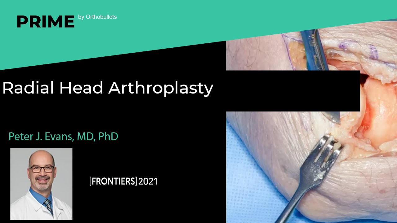 Radial Head Arthroplasty Peter J. Evans, MD, PhD YouTube