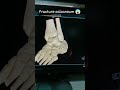 “Dangerous Heel Injury 💥 Calcaneum Fracture Real Case!” #Radiology #Xray #MedicalEducation” #ct