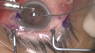 Retinal forceps for Explantation of IOL