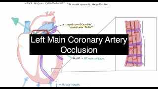 Left Main Coronary Artery Occlusion - Pathophysiology