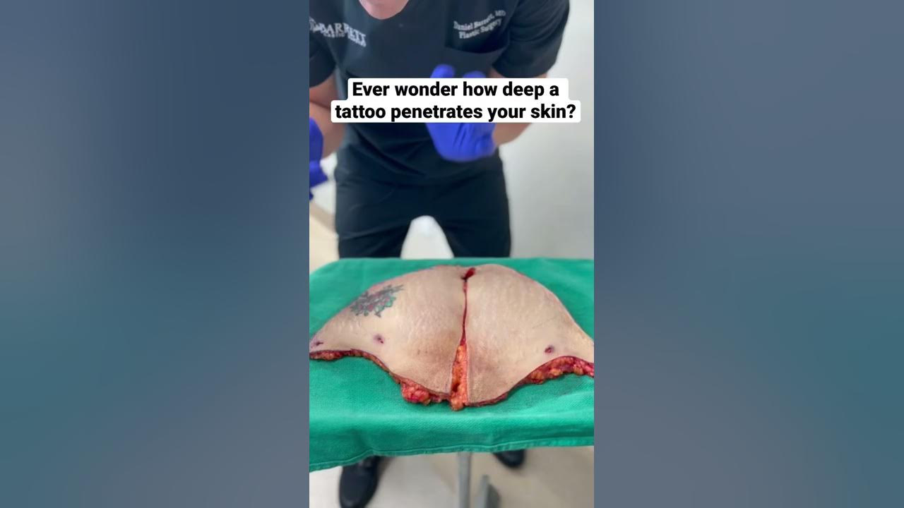 Ever wonder how deep a tattoo penetrates your skin?!😱 #mommymakeover #liposuction #tummytuck