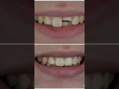   تركيب زيركون  