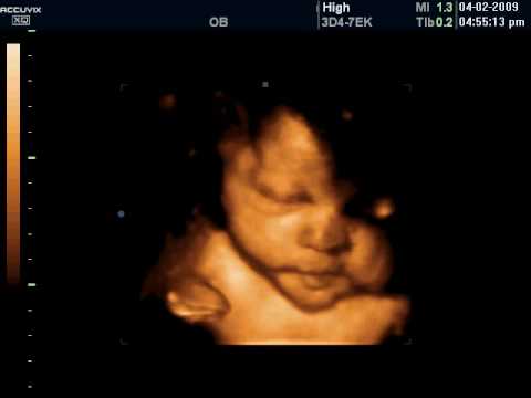 3D/4D ultrasound - 34 weeks