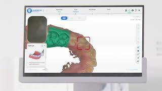 Shining3D Aoralscan 3 Intraoral Scanner - Scan Procedure