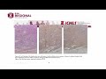 CML as a Secondary Malignancy