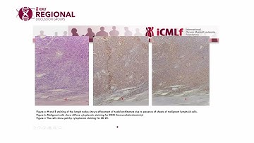 CML as a Secondary Malignancy