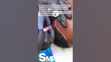 Discover the Power of Scalp Micropigmentation (SMP) at EDEN AESTHETICS Clinic Dubai